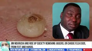 Popping Around the World!  Blackheads and Pimples