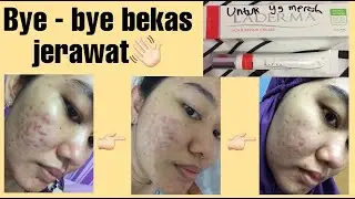 REVIEW LADERMA SALEP PENGHILANG BEKAS LUKA JERAWAT | MEMBANTU MENYEMBUHKAN LUKA LAMA DAN LUKA BARU