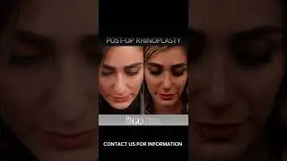 Before and After Rhinoplasty - Dr Guncel Ozturk 