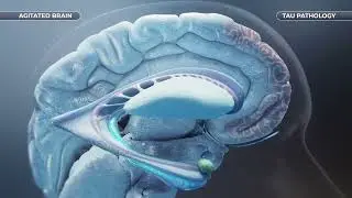 Agitation associated with Alzheimer’s Dementia: Mechanism of Disease