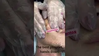The best pimples, hands down