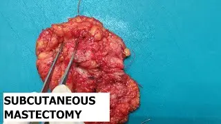 Subcutaneous mastectomy specimen