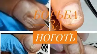 Онихолизис. Идём на поправку.