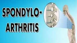 Spondyloarthropathy