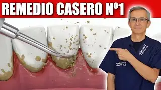 Nº1 REMEDIO CASERO para ELIMINAR la PLACA, el SARRO y PREVENIR la CARIES