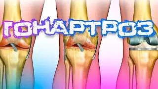 What is gonarthrosis? Causes of gonarthrosis. Treatment of gonarthrosis.