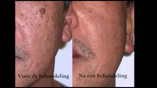Ouderdomsvlekken, lentigo, lentigines, levervlekken worden behandeld in de Dermakuurpraktijk