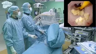 Flexible ureteroscopy and laser lithotripsy in ureter of an obstructing stone