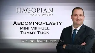 Mini vs Full Tummy Tuck: Why Most Patients Benefit From the Full Approach