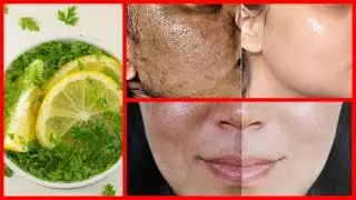 MANCHAS NA PELE, MELASMA, ACNE -ESSE REMÉDIO VAI ACABAR COM ELA ENQUANTO VOCÊ DORME