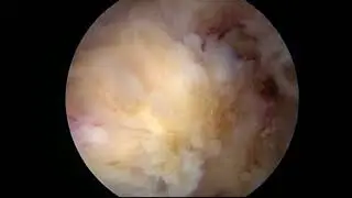 The 1st Trial of 3D biportal endoscopic laminotomy_ULBD