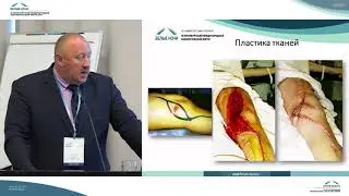 Ревизионные оперативные вмешательства  в лечении опухолей костей конечностей