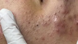 Acne treatment for Quang (P1) #HoangMySpa74