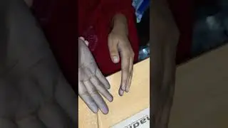 Raynauds Disease