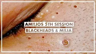 Amilios 5th Session - Blackheads And Milia Extraction On The Face