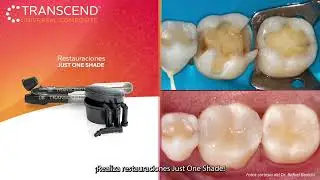 Transcend™ Universal Composite