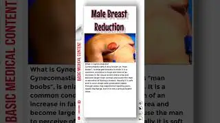 Male Breast Reduction 