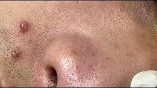 Blackheads on nose, inflammatory acne#HoangMySpa121