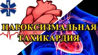 Пароксизмальная тахикардия