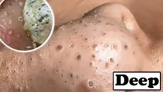 Super Removal Of Blackheads On Nose Satisfy And Relaxing