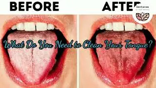 how to get rid of white tongue |Easy way to clean your tongue by Dr Rajni Bala
