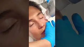Ultraformer III: La solución definitiva para arrugas en ojos