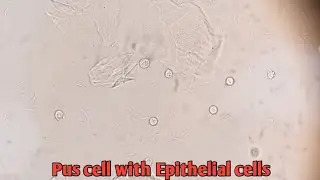 Urine microscopy 🔬|Pus cell withepithelialcell on microscopyExamination|