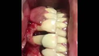Gingival flap surgery - solution for bleeding gums and loose teeth