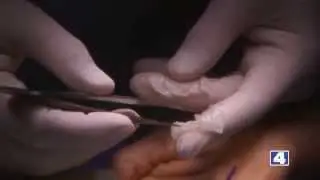 The Science Of Healing: Reconstructive Surgery & Limb Regrowth