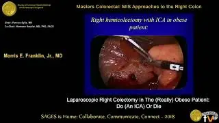 Laparoscopic right hemicolectomy in (really) obese patients