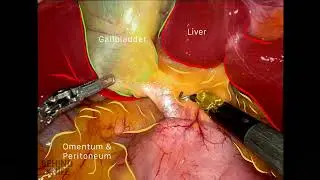 Behind the Knife - Robotic Cholecystectomy