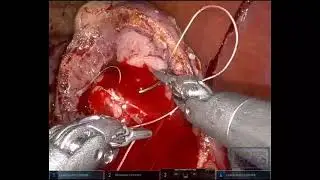 Right Partial Nephrectomy