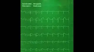 Brugada