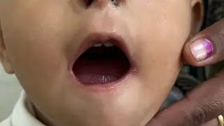Identify the Syndrome