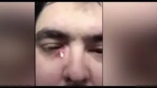 *EXPLOSIVE EYE PIMPLE** HUGE PIMPLE POPPING & MORE