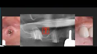 An Alternative to Lateral Sinus Lift