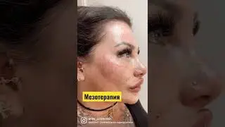 Как сделать  кожу красивой ?Мезотерапия