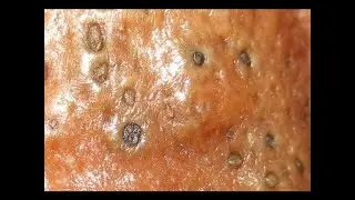 Extraccion de granos,pelos encarnados y quistes