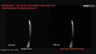 Medic Vision MRI finger scan - 33% time reduced and image enhanced. scanner - GE Signa 1 5T