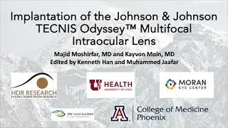Odyssey TECNIS IOL Implantation