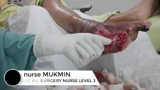 HABISKAN NANAH NYA DULU BARU BERSIHKAN LUKANYA