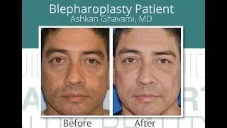 Rejuvenating the Eyes with Blepharoplasty