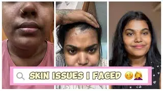 🤦‍♀️Skin issues I faced😱😤|#malayalam #vlog #subscribe #trending #skin #vlogs