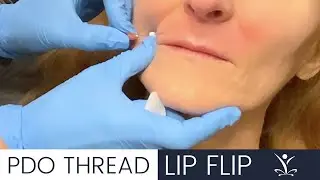 Get a Lip Flip with PDO Threads