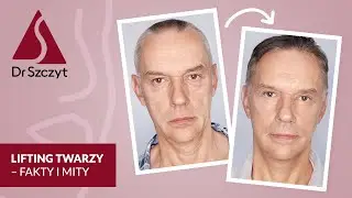 Lifting twarzy - fakty i mity