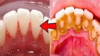 How to Stop Receding Gums | Treatments, Pain Solutions.