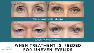 When Eyelid Asymmetry Needs Treatment, and the Different Causes of Uneven Eyes