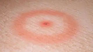 Enfermedad de Lyme