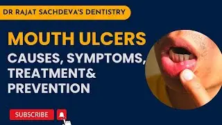 Mouth Ulcers | What causes mouth ulcers? |  Mouth ulcers treatment | Dental LASERS for ulcers