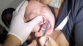 Something Trapped & Stuck in Girl's Nose Removal